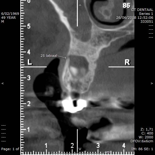 CBCT voorbeeld 1: sagittale doorsnede