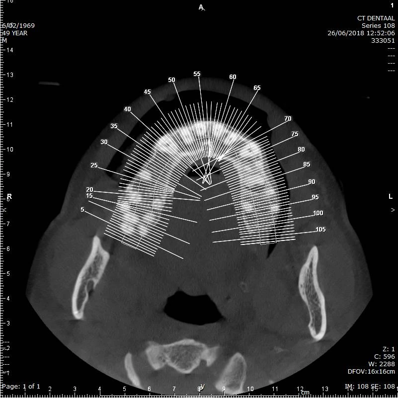 CBCT voorbeeld 2: axiale doorsnede