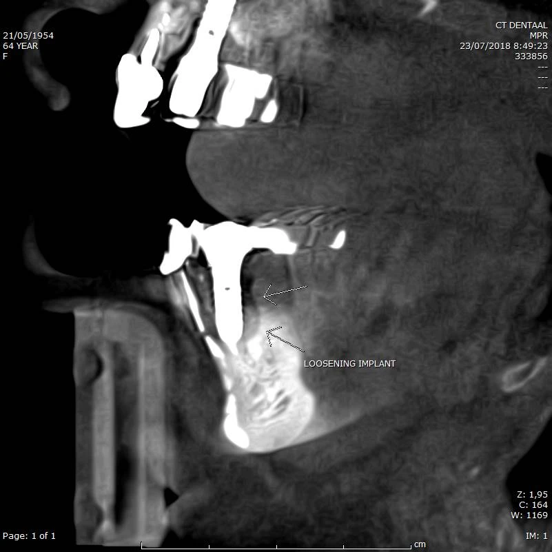CBCT voorbeeld 3: loszittend implant