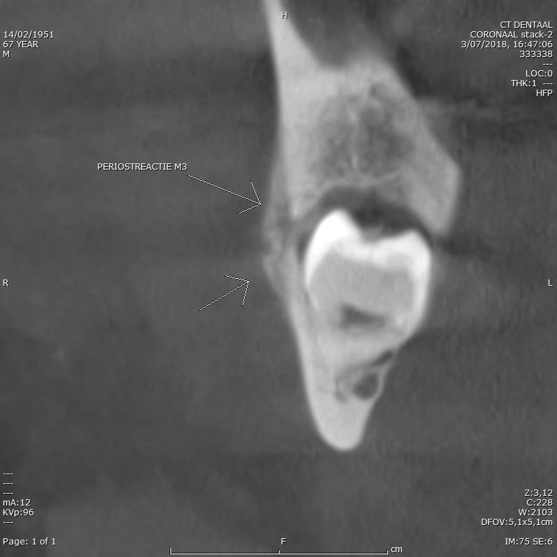 CBCT voorbeeld 4: periostreactie M3