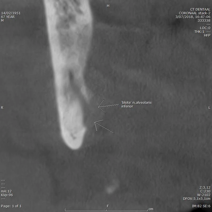 CBCT voorbeeld 5: blootliggende nervus alveolaris inferior