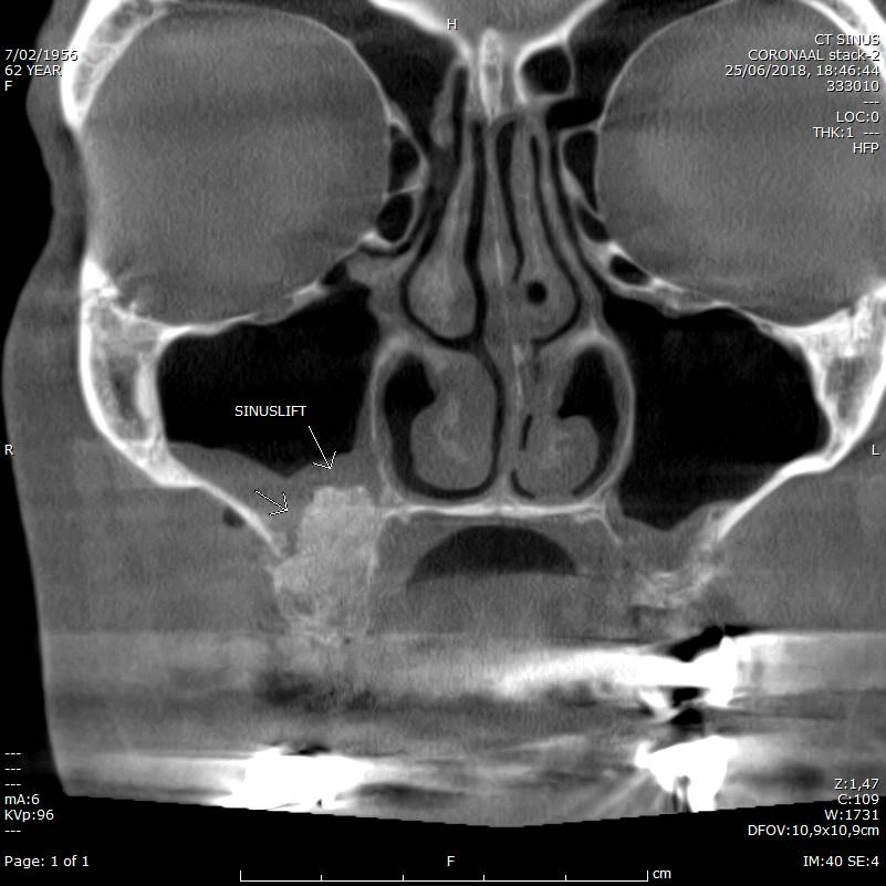CBCT voorbeeld 6: sinuslift coronal