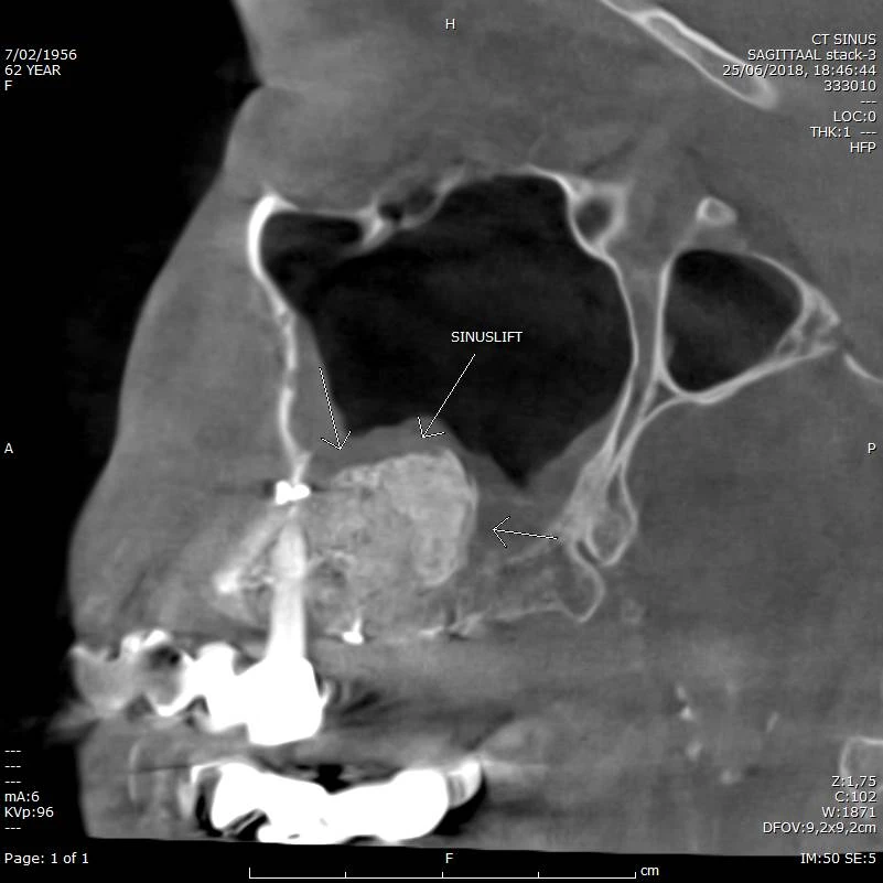 CBCT voorbeeld 7: sinuslift sagittaal