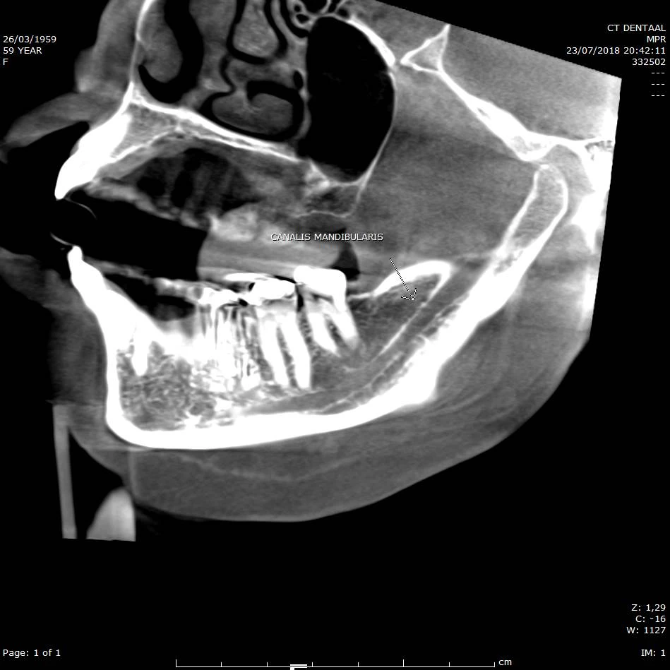 CBCT voorbeeld 8: canalis mandibularis sagittaal